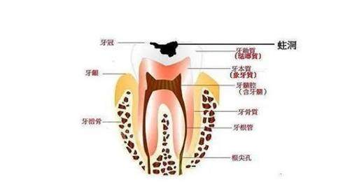 牙髓炎示意图