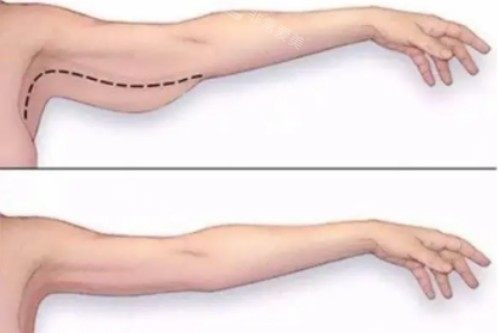 韩国欧尼在线解答:韩国手臂吸脂去哪里做好?需要准备多少钱?技术怎么样?