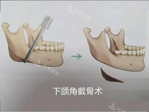 下頜角截骨術(shù)卡通示意圖 下頜角截骨術(shù)卡通示意圖
