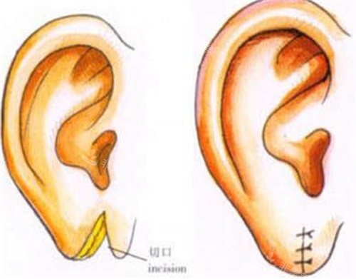 韩国耳再造技术怎么样，分享我在韩国的耳再造手术经历！