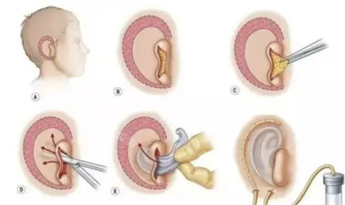 韩国耳再造技术怎么样，分享我在韩国的耳再造手术经历！