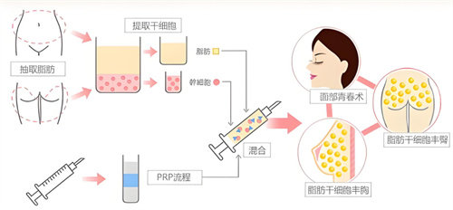 自體脂肪隆胸過程