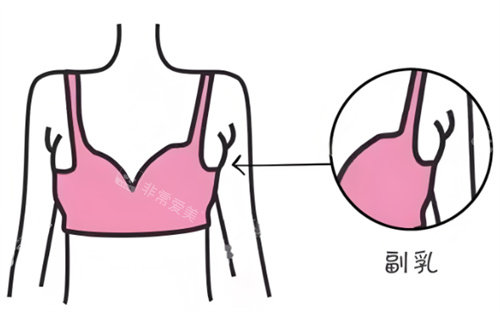 副乳好难减！令人烦忧的腋下副乳能消退吗？手术去副乳全纪录~