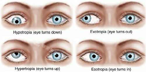 不同眼睛斜视和正常眼睛的对比