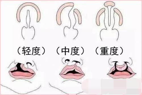 详细揭秘:韩国Noselips整形外科（原mvp整形医院）唇腭裂修复怎么样?价格是多少?