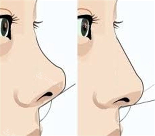 鼻整形前后对比图