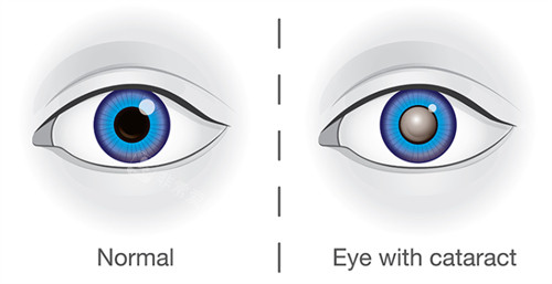 正常眼睛和白内障眼睛不同