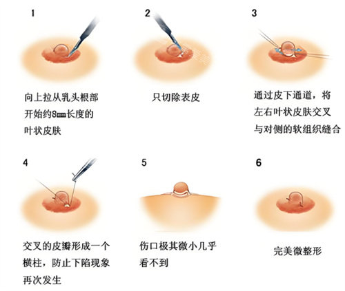 乳头内陷矫正手术过程