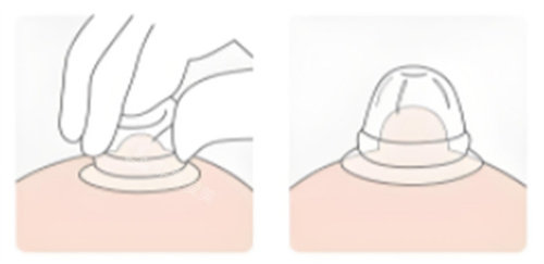 乳头内陷矫正器使用