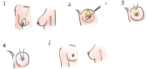 乳房下垂矫正术过程