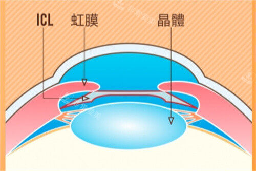 ICL示意图