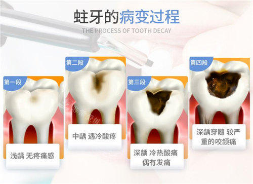 蛀牙的发展过程