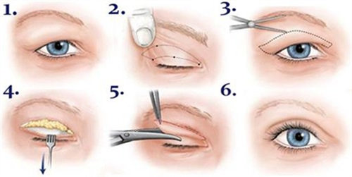 双眼皮全切术过程图