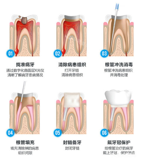 根管治疗流程示意图