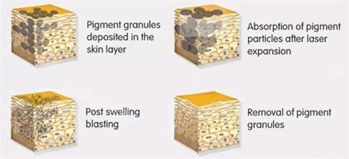 激光祛斑过程变化图