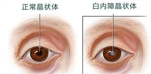 深扒:韩国白内障手术医院排名榜中明目眼科丨ES友利眼科丨江南W眼科哪家好?