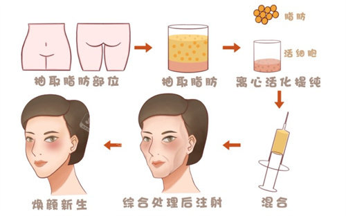 脂肪填充面部 脂肪填充面部