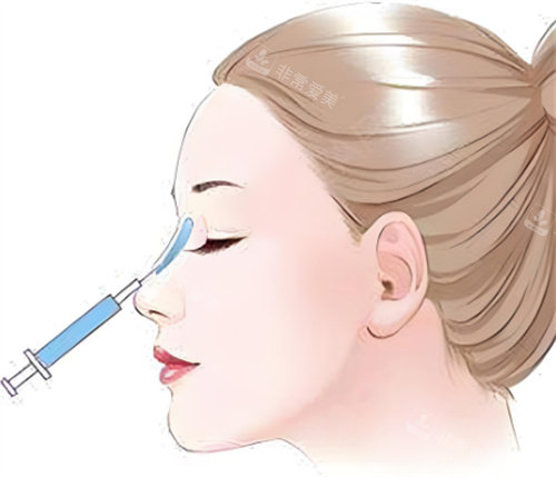 隆鼻玻尿酸注射图示