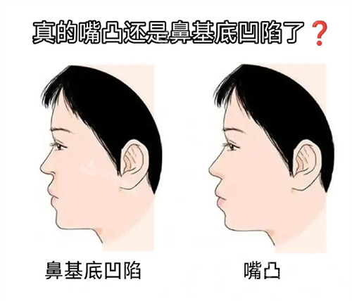 鼻基底凹陷和嘴凸的区别