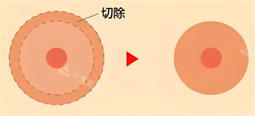 乳暈縮小術(shù)對比