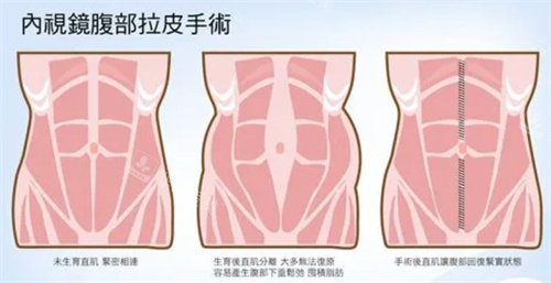 内窥镜腹部拉皮手术过程