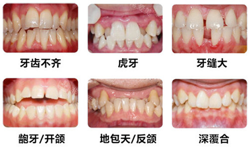 牙齿矫正适应症展示