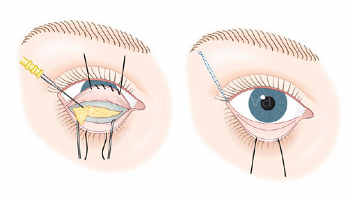 下眼睑手术图