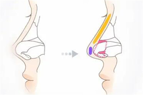鼻尖整形展示图