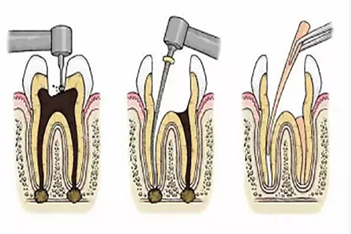 根管治疗步骤1