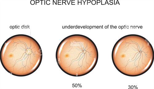 视神经萎缩不同程度表现形式