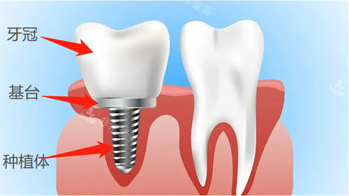 种植牙