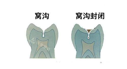 窝沟封闭前后的对比图