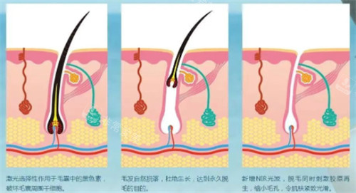 光子脫毛前后