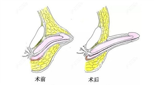 男性私密手术前后对比