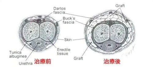 男科手术前后对比