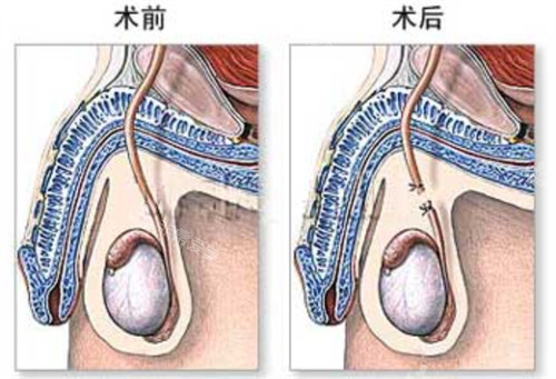 男性結(jié)扎手術(shù)