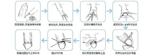 割包皮手術(shù)過(guò)程