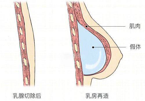 胸再造示意图