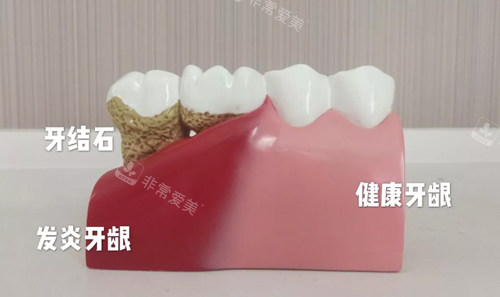 牙结石和牙龈图