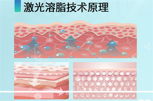 激光溶脂原理 激光溶脂原理