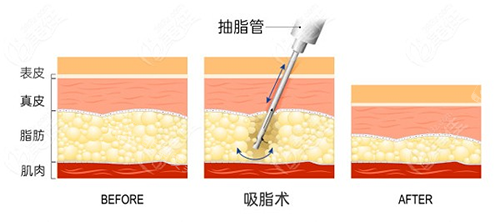 吸脂手术方法