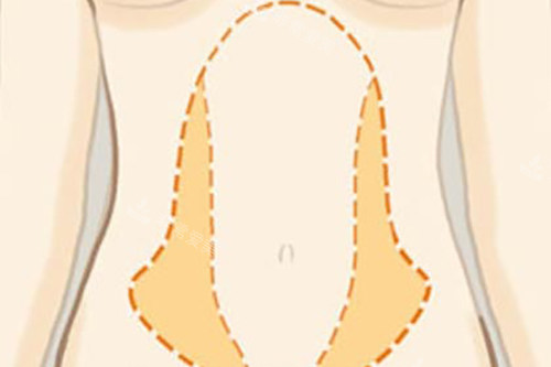 腰腹吸脂位置示意图