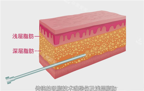 深层脂肪和浅层脂肪 深层脂肪和浅层脂肪