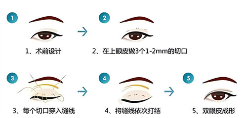 双眼皮三点术过程原理