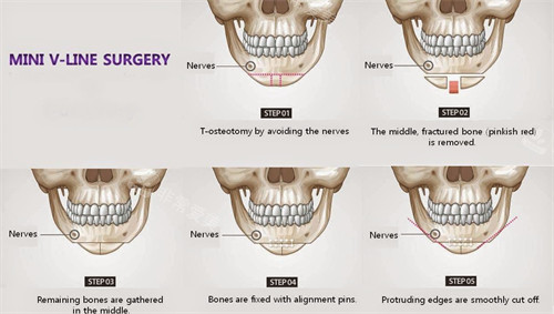 下巴截骨手术过程