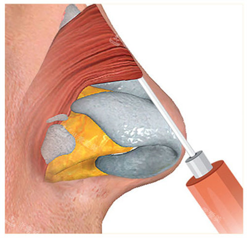 玻尿酸注射隆鼻过程图