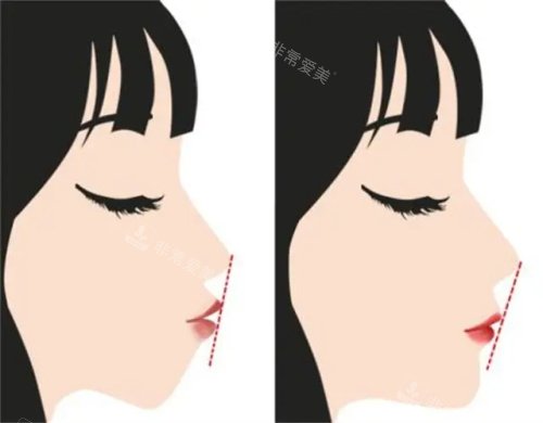 正頜手術(shù)前后的對比圖 正頜手術(shù)前后的對比圖