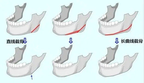 下颌骨截骨整形卡通示意图