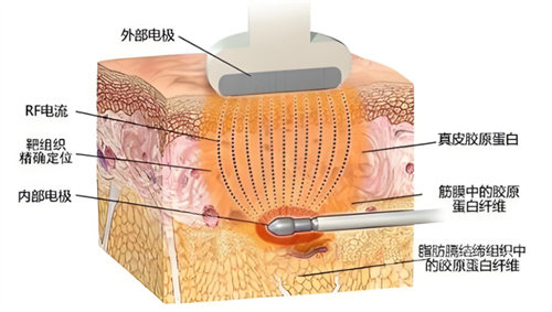 做激光溶脂瘦腰靠谱吗？大出意料！溶脂两个月了我来谈谈~