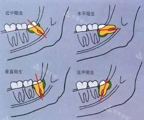 不同智齿图示